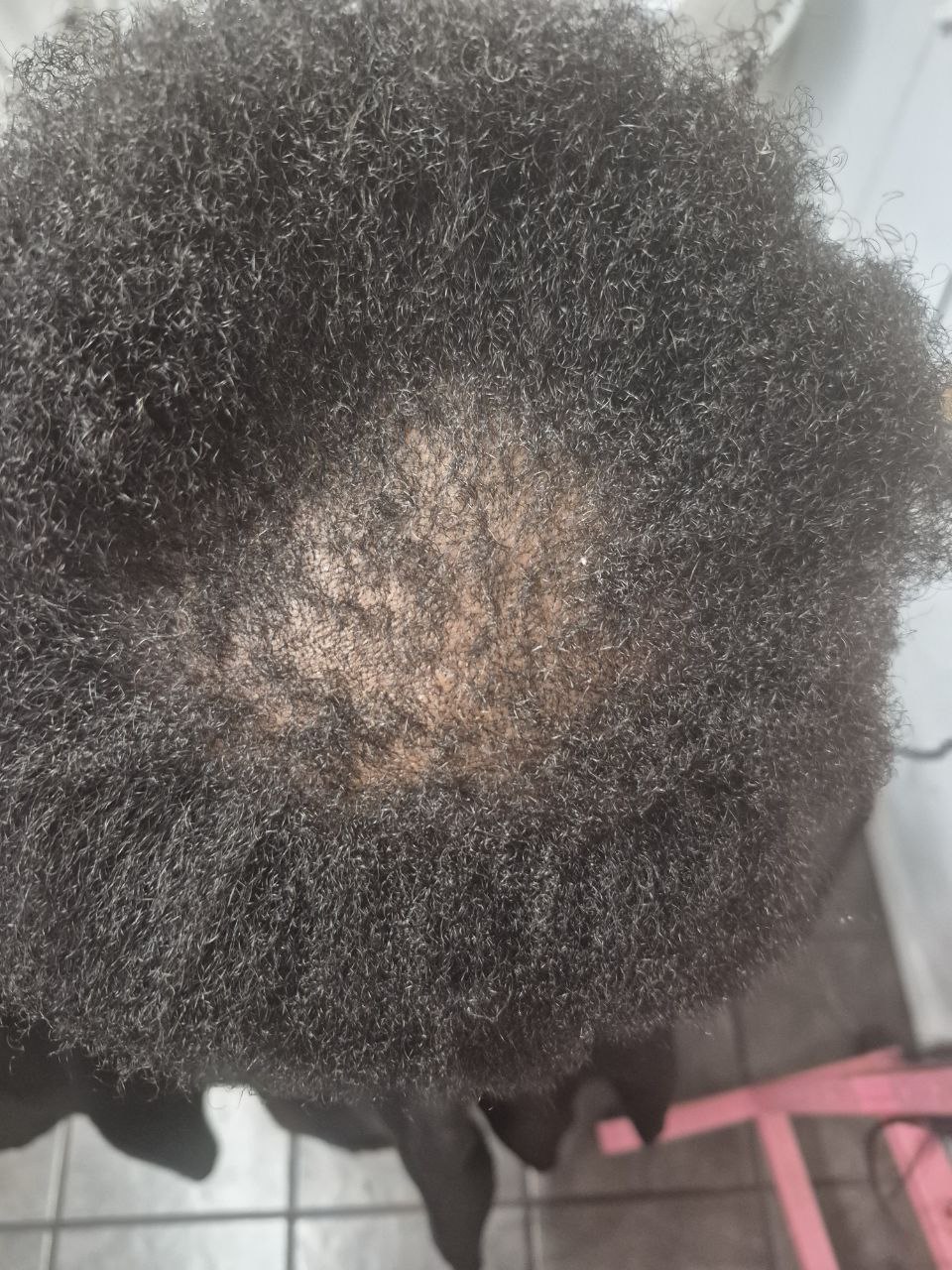 Alopecia Coverup protective style - Tucson hair braiding by Milly's FAB