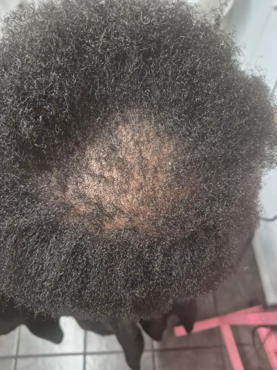 Alopecia Coverup protective style - Tucson hair braiding by Milly's FAB